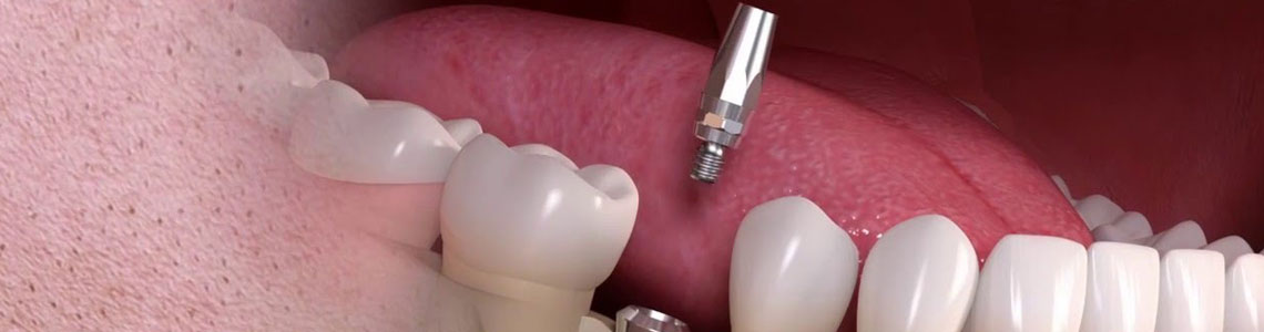 implantes-dentales-straumann-marca implantes dentales